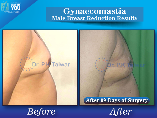 Gynaecomastia before after image